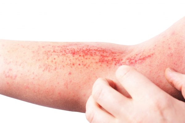 Preventing Contact Dermatitis Level 2 Award